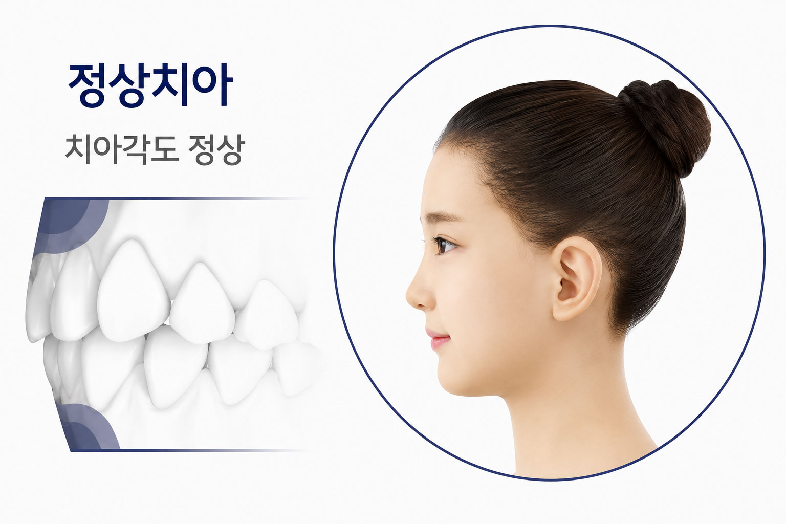 정상치아 — 치아각도 정상