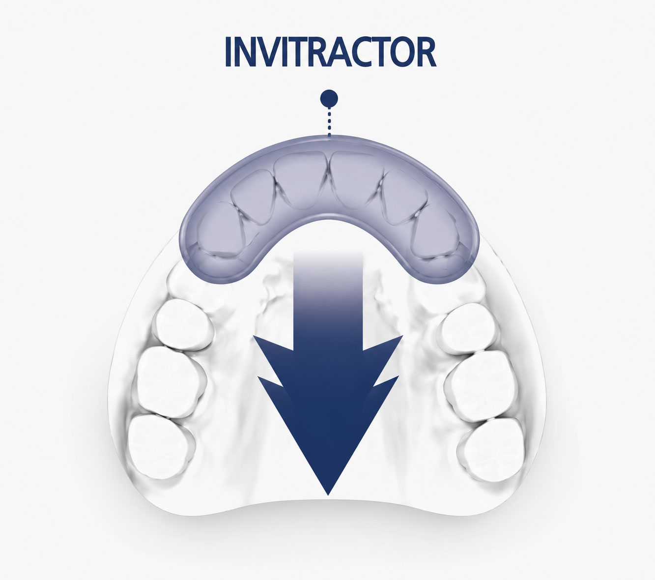 INVITRACTOR — 교정 시작 직후 치아 견인 진행