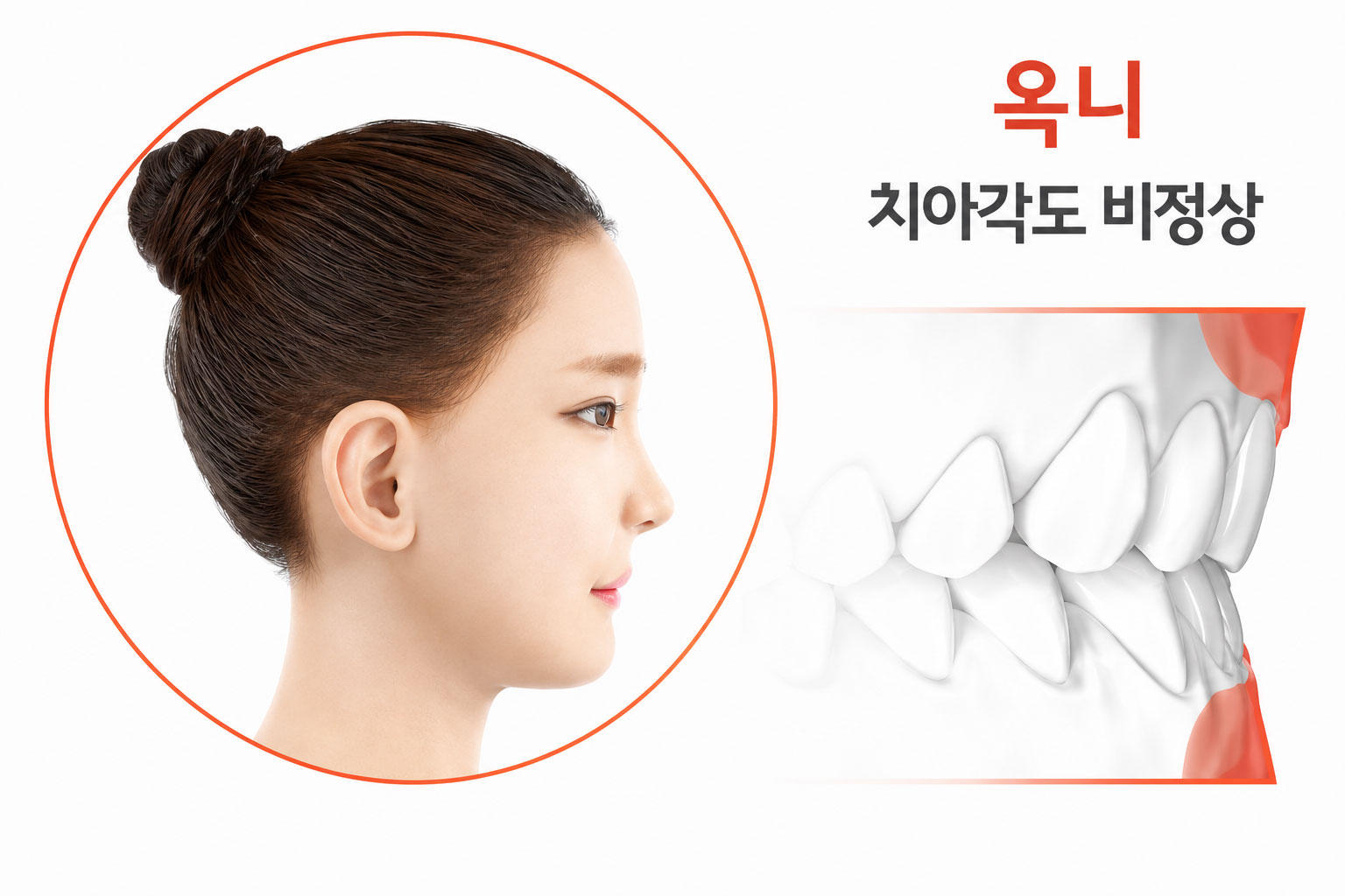 옥니 — 치아각도 비정상