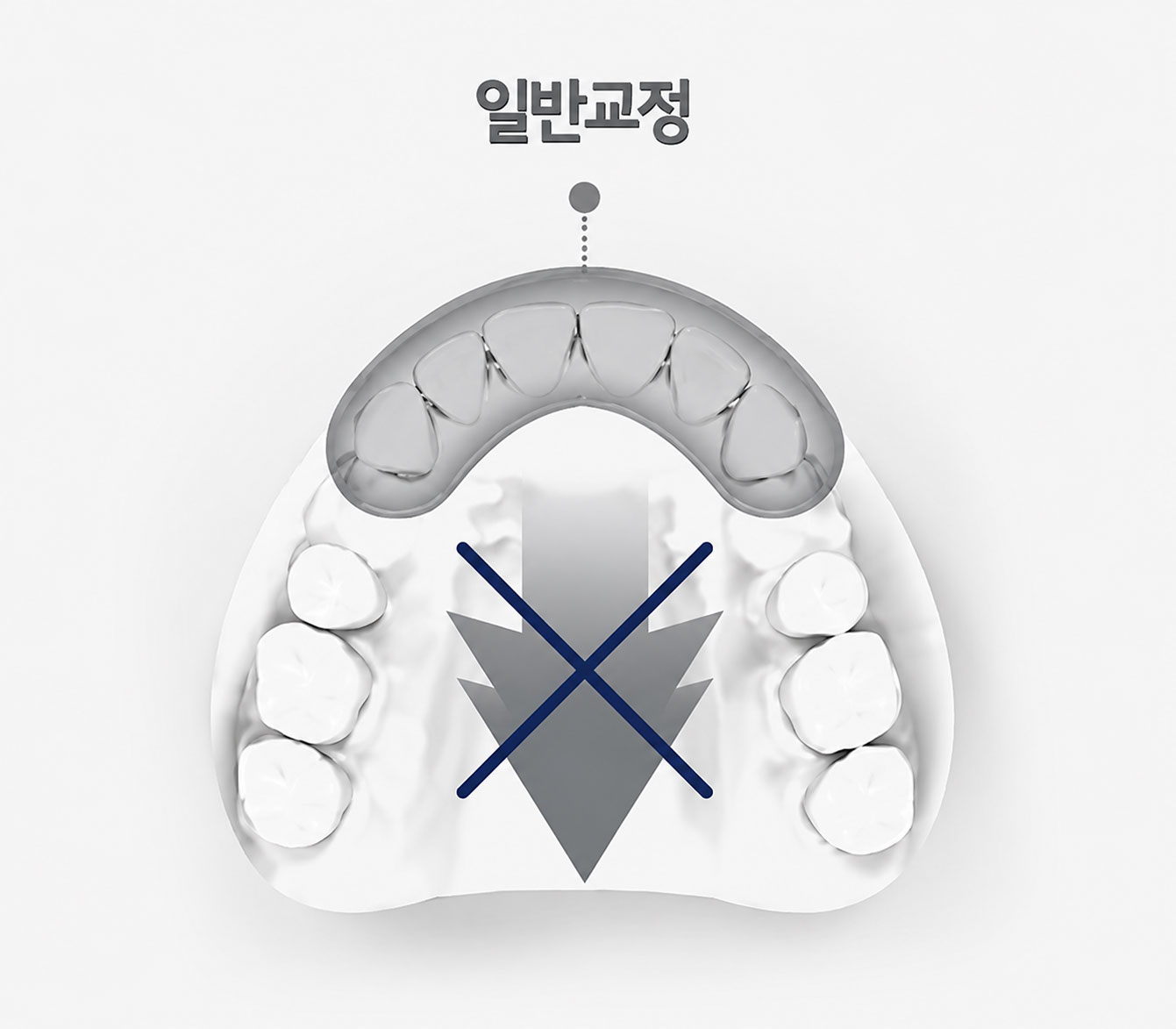 일반 교정 — 치아 배열 선행 후 견인